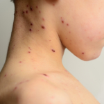 Mässling: orsak, symtom & behandling